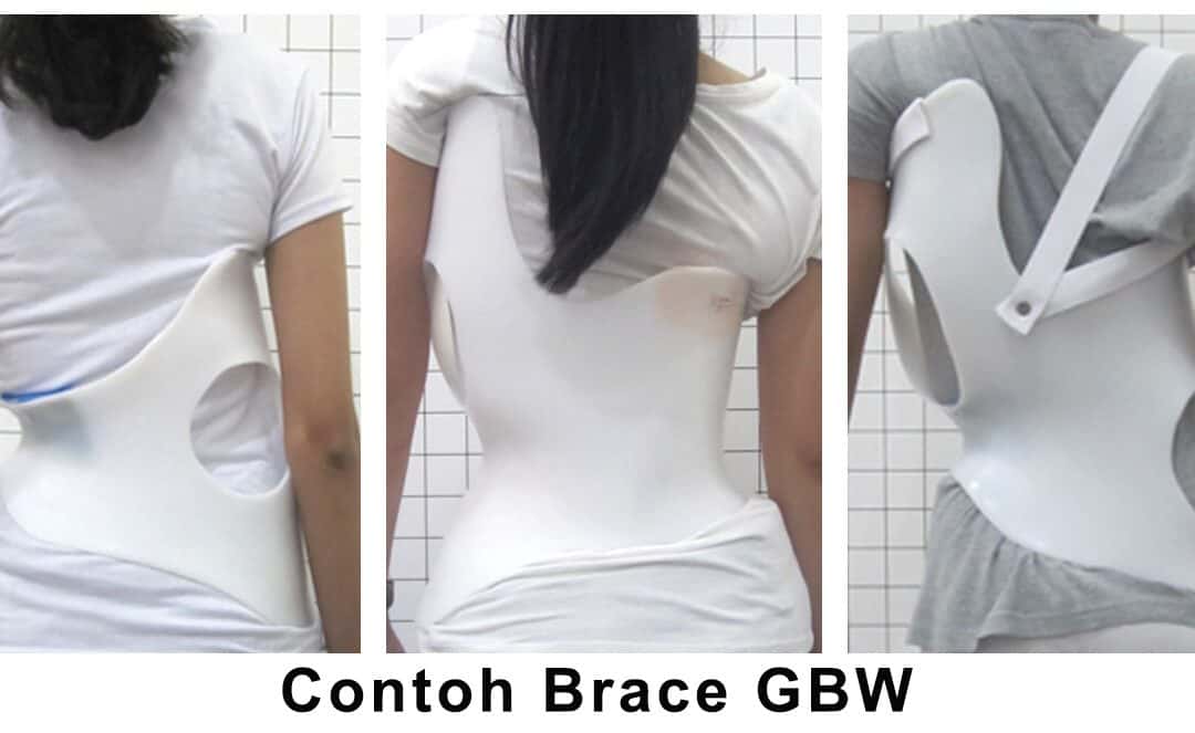 7 Perbedaan Brace Scoliosis GBW dan Brace simetris