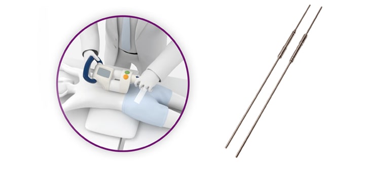 Magec Rods: Operasi Skoliosis Teknik Baru yang perlu Dipertanyakan