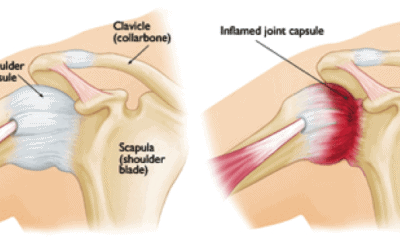Frozen Shoulder atau Bahu Beku