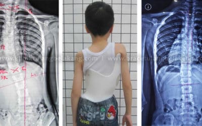 Deteksi Dini Scoliosis + Pengobatan yang tepat = Kesembuhan yang pasti!