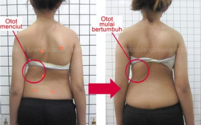 Otot dapat bertumbuh kembali setelah pemakaian Brace GBW