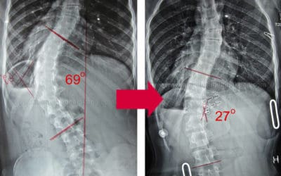 Brace GBW untuk Skoliosis dengan derajat lebih dari 60°