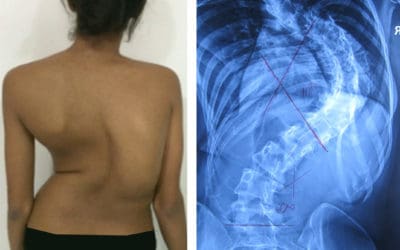 Jangan menunggu Scoliosis Anda membesar koreksi dari sekarang