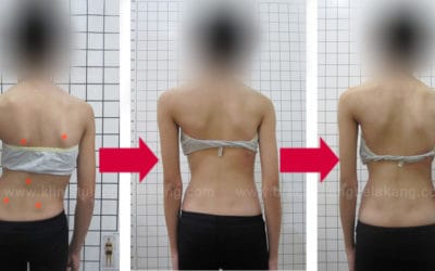 Lagi.. Hasil menggembirakan dari Pasien Scoliosis Brace GBW