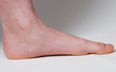 Perburukan Skoliosis dapat disebabkan ketidakseimbangan Telapak Kaki